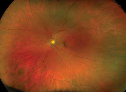 normal retina